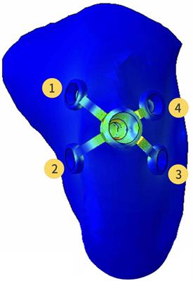Biomechanical evaluation of custom-made short implants with wing retention applied in severe atrophic maxillary posterior region restoration: A three-dimensional finite element analysis